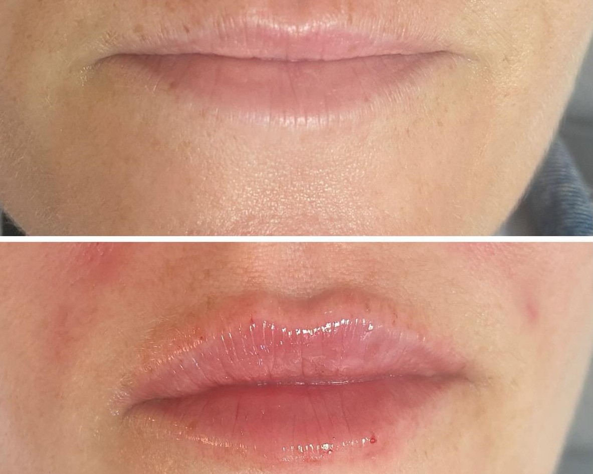 Eksempel på fillerbehandling i Aalborg før og efter