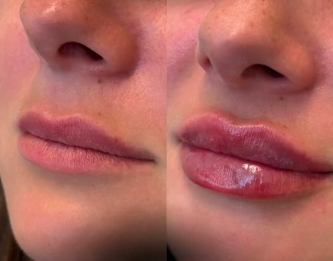 Lip filler i Aalborg med fokus på naturligt resultat og balanceret form