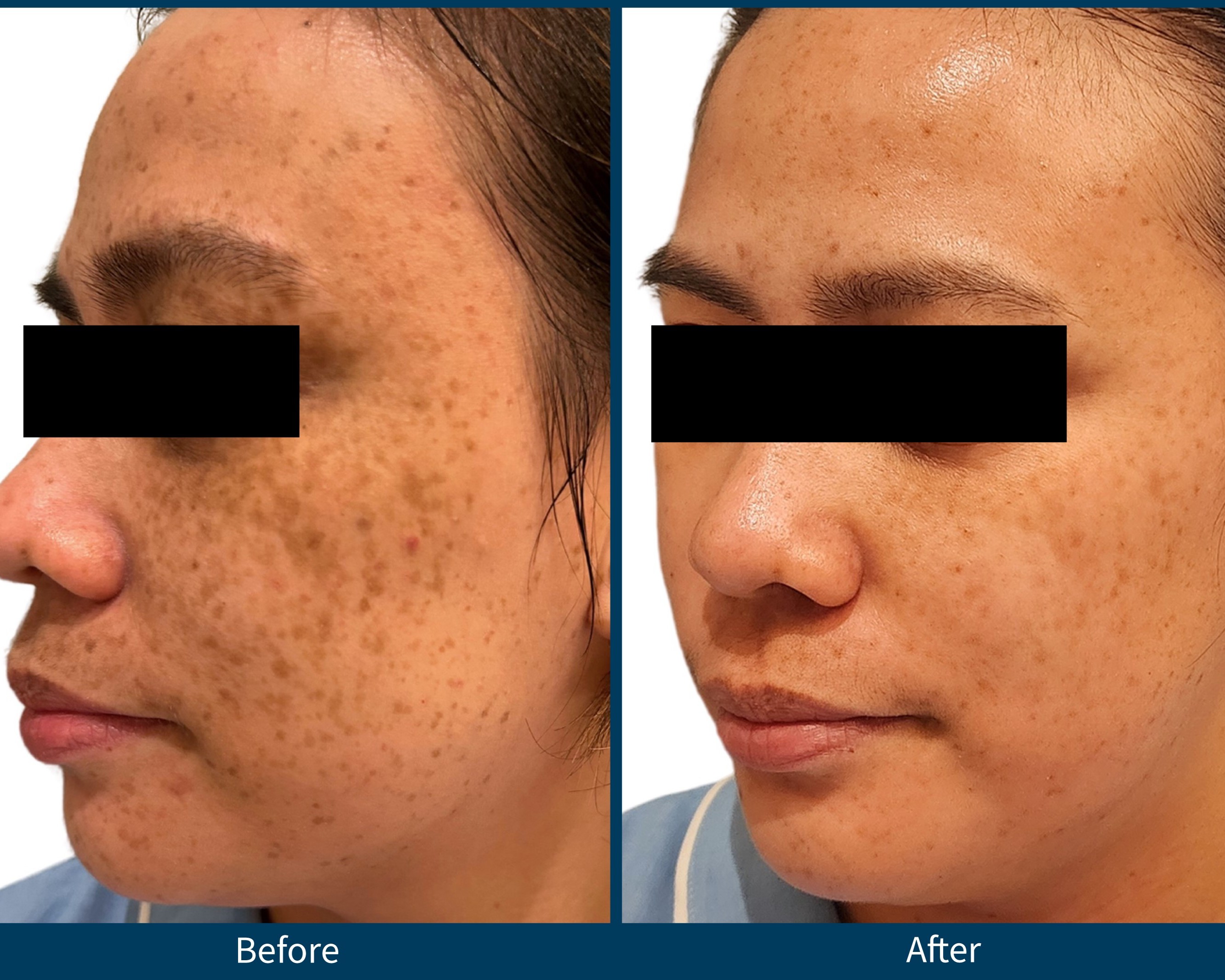 SkinPen behandling i Aalborg