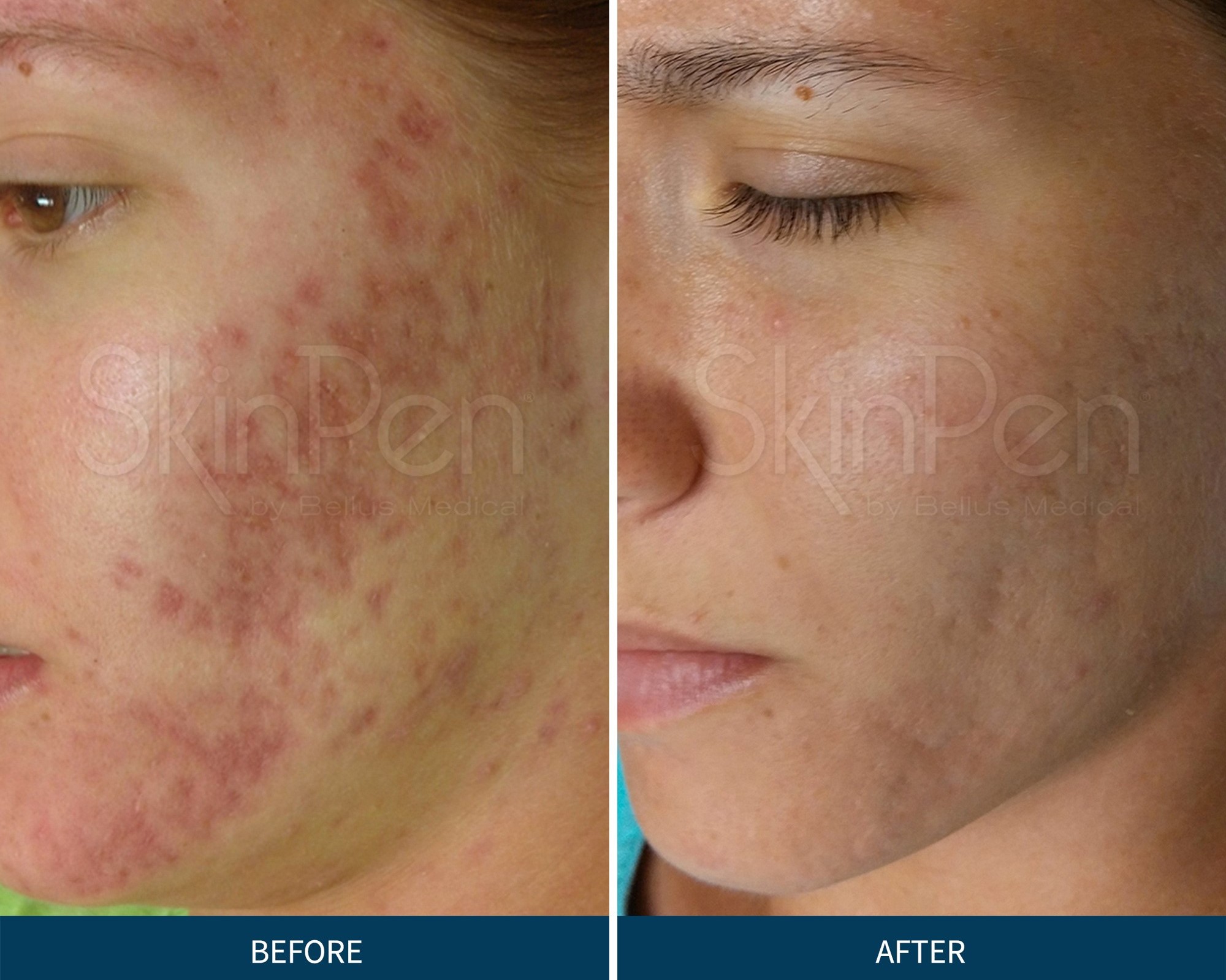 Microneedling med SkinPen i Aalborg