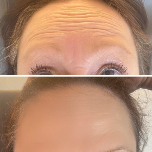 Botox behandling i Aalborg på klinik i Aars