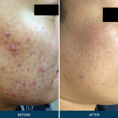 SkinPen microneedling mod akne ar nær Aalborg