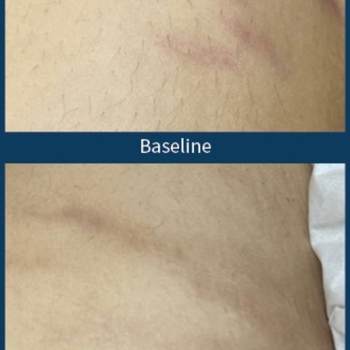 Microneedling med SkinPen mod strækmærker nær Aalborg