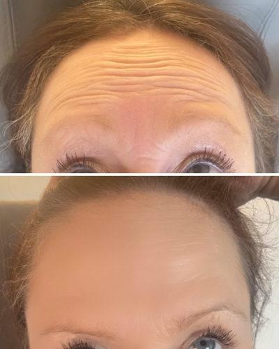 Botox behandling i Aalborg på klinik i Aars