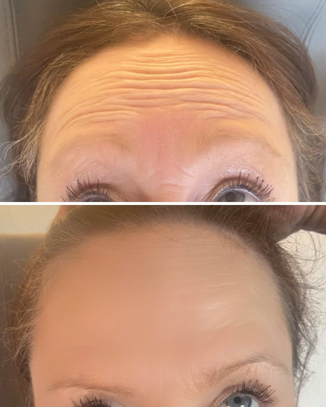 Botox behandling i Aalborg på klinik i Aars