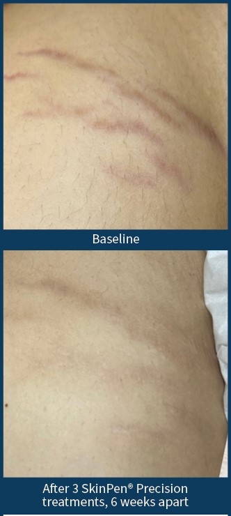 Microneedling med SkinPen mod strækmærker nær Aalborg