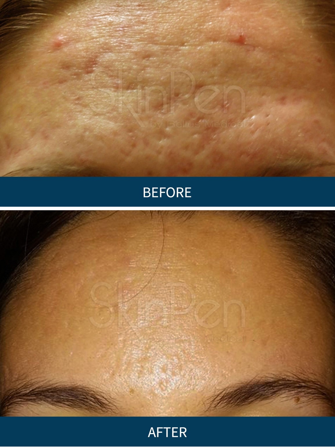 SkinPen behandling af ansigtet nær Aalborg